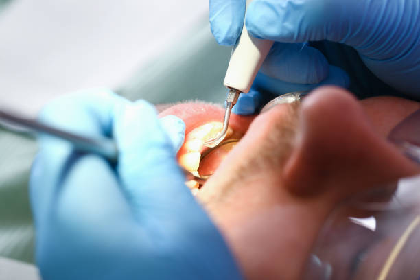 Best Emergency Tooth Extraction in Haskell, TX