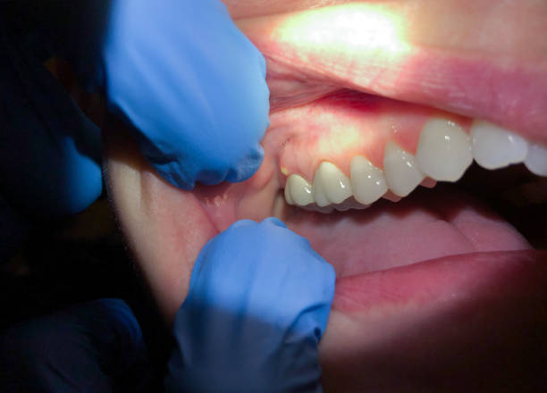 Best Emergency Treatment for Dental Infections or Abscesses in Haskell, TX